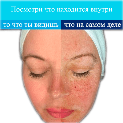 Пигментация и веснушки 400x400 Пигментация и веснушки