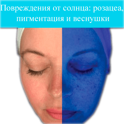Пигментация и веснушки 400x400-1 Пигментация и веснушки