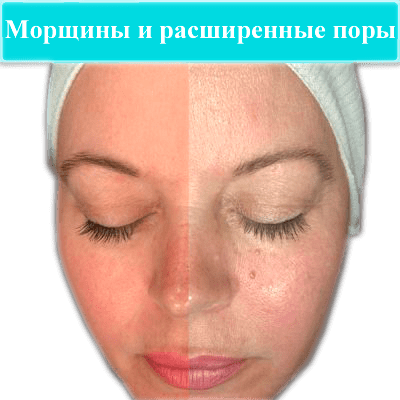 Морщины и расширенные поры 400x400-1 Морщины и расширенные поры