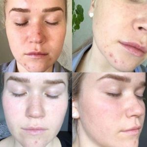 Всё о прыщах